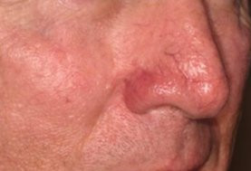 До и после процедуры