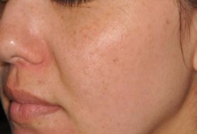 До и после процедуры