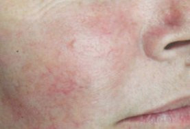 До и после процедуры