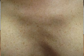 До и после процедуры