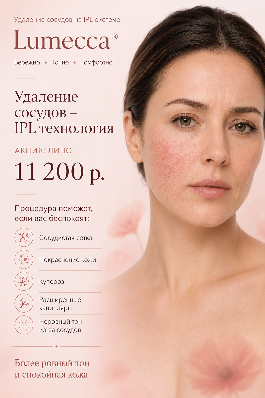 IPL - Удаление сосудов 11200р.