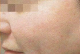 До и после процедуры