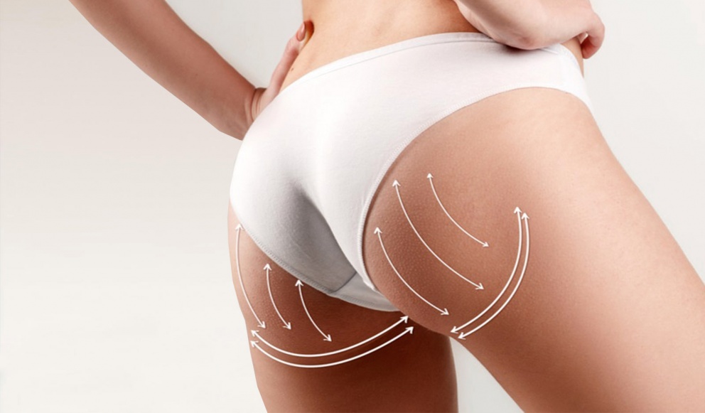 Нитевой лифтинг: коги / аптос