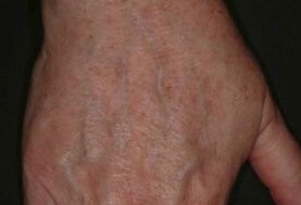 До и после процедуры