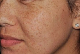 До и после процедуры