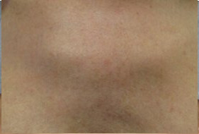 До и после процедуры