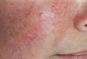 До и после процедуры