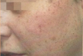 До и после процедуры