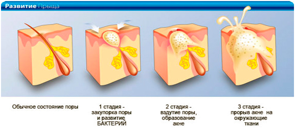Развитие прыща
